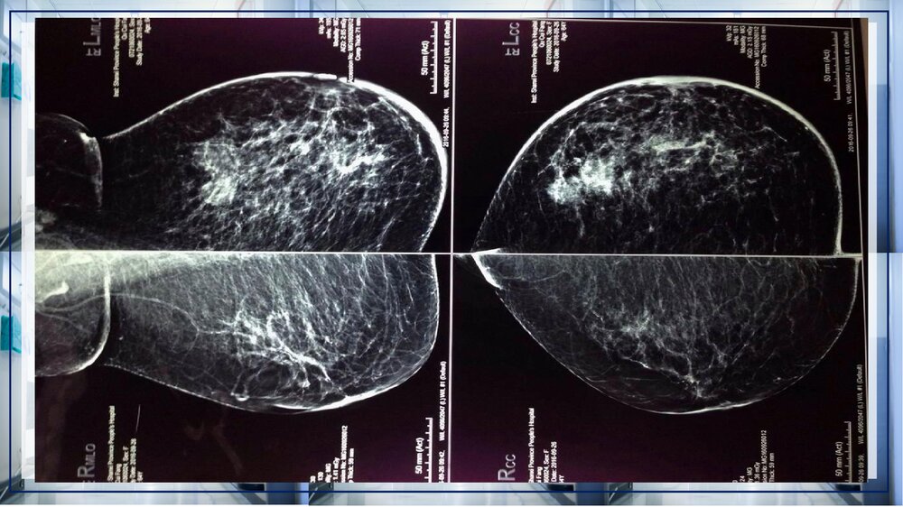 乳腺癌病例讨论PPT课件下载(带内容·共13页)10