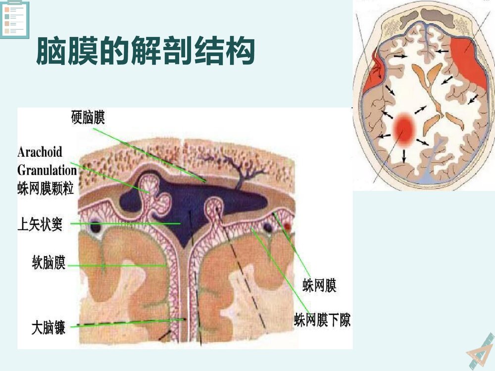 慢性硬膜下血肿的影像诊断与鉴别诊断PPT课件下载(共23页)4