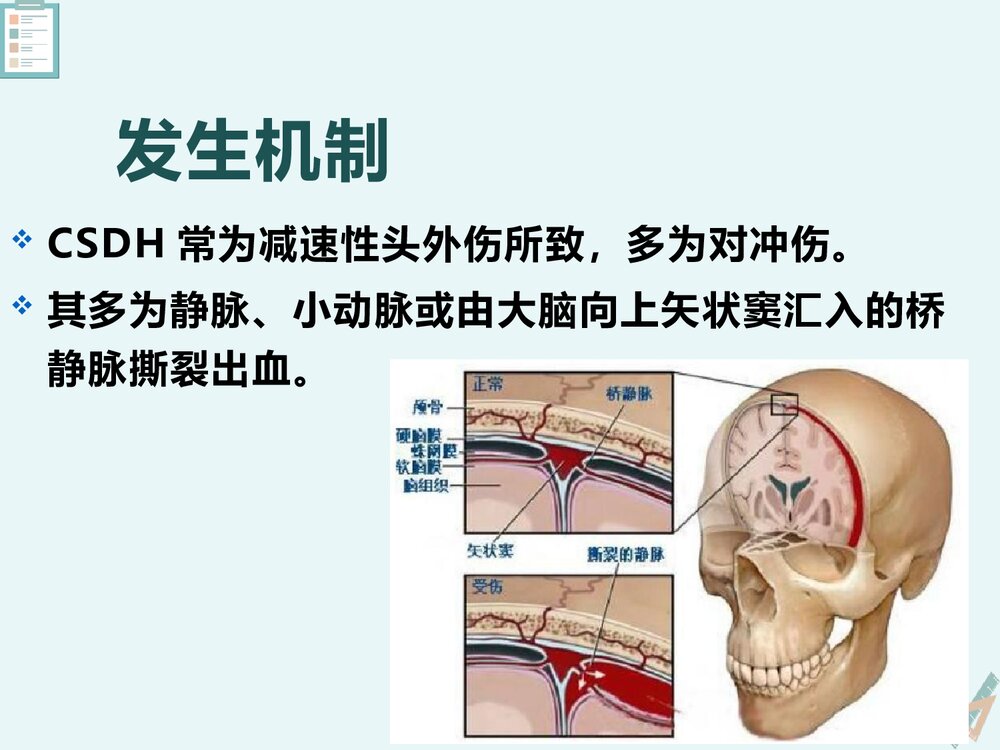 慢性硬膜下血肿的影像诊断与鉴别诊断PPT课件下载(共23页)6