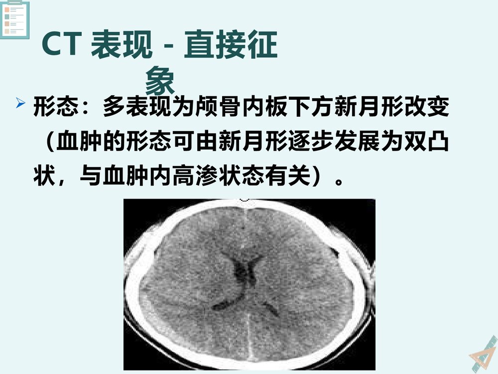 慢性硬膜下血肿的影像诊断与鉴别诊断PPT课件下载(共23页)8