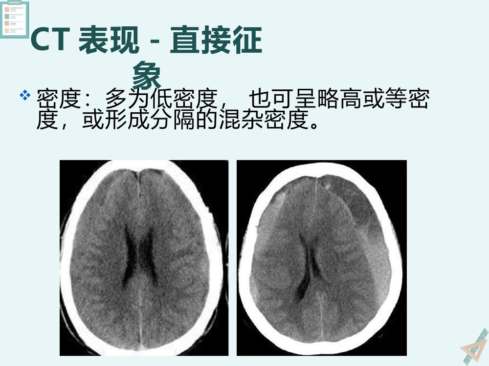 慢性硬膜下血肿的影像诊断与鉴别诊断PPT课件下载(共23页)9