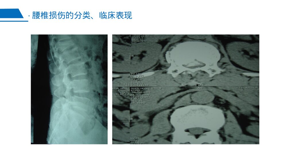 腰椎骨折PPT课件下载(含内容·共25页)9