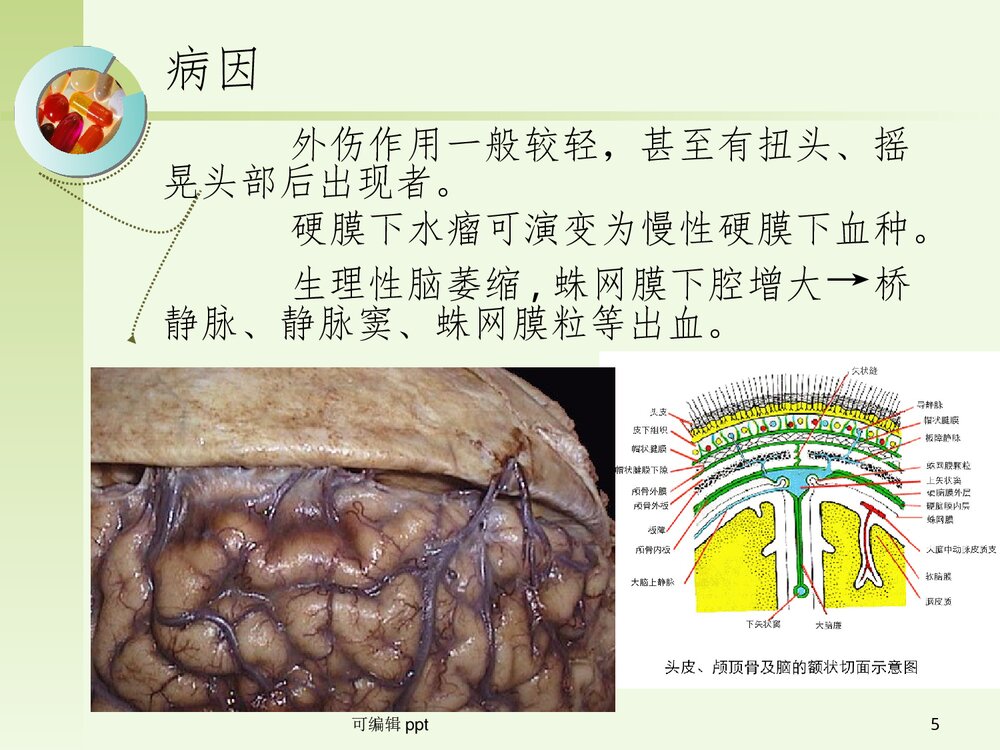 颅脑创伤之慢性硬膜下血肿PPT课件(共42页)5