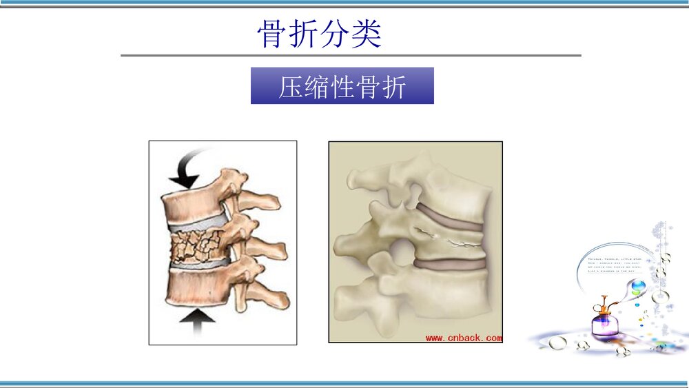 腰椎骨折护理查房PPT课件(共32页)7