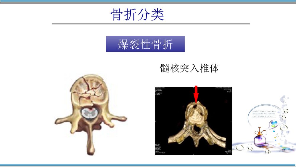 腰椎骨折护理查房PPT课件(共32页)8