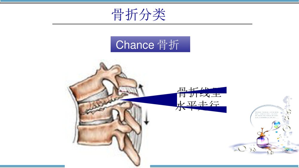 腰椎骨折护理查房PPT课件(共32页)9