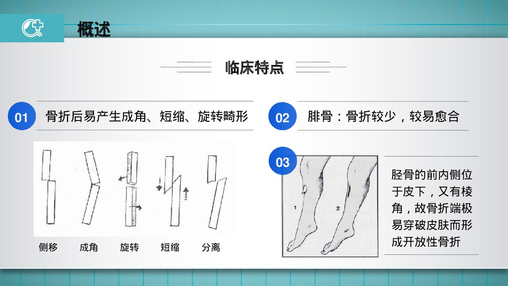 胫腓骨骨折的护理PPT课件(共23页·可编辑修改)6