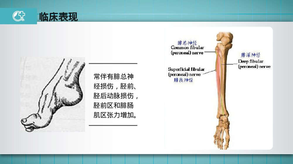 胫腓骨骨折的护理PPT课件(共23页·可编辑修改)10