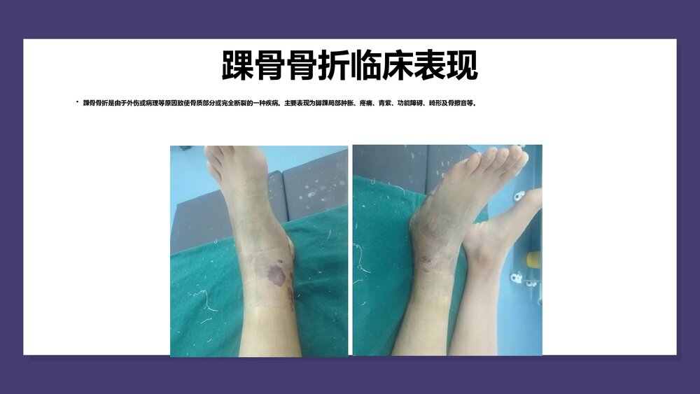 三踝关节骨折护理查房PPT课件（共29页）5