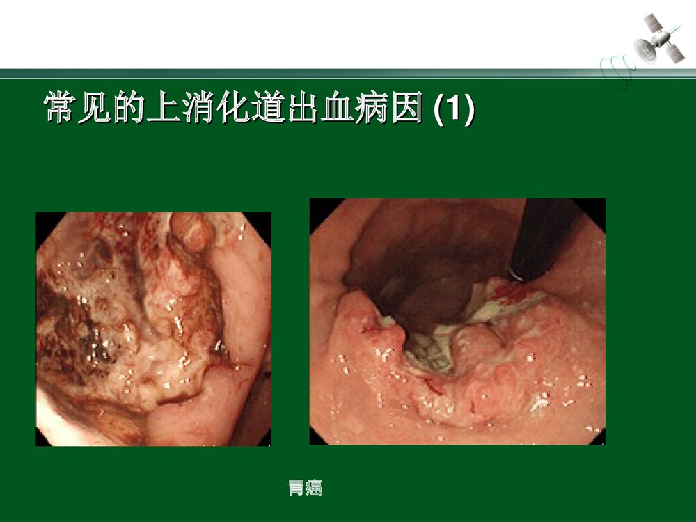 上消化道出血的急救与护理PPT课件下载(共28页)6