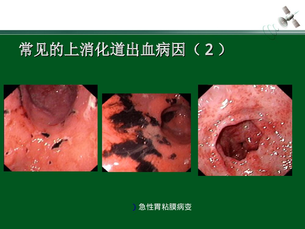 上消化道出血的急救与护理PPT课件下载(共28页)7