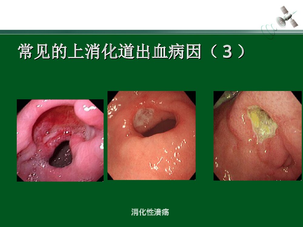 上消化道出血的急救与护理PPT课件下载(共28页)8