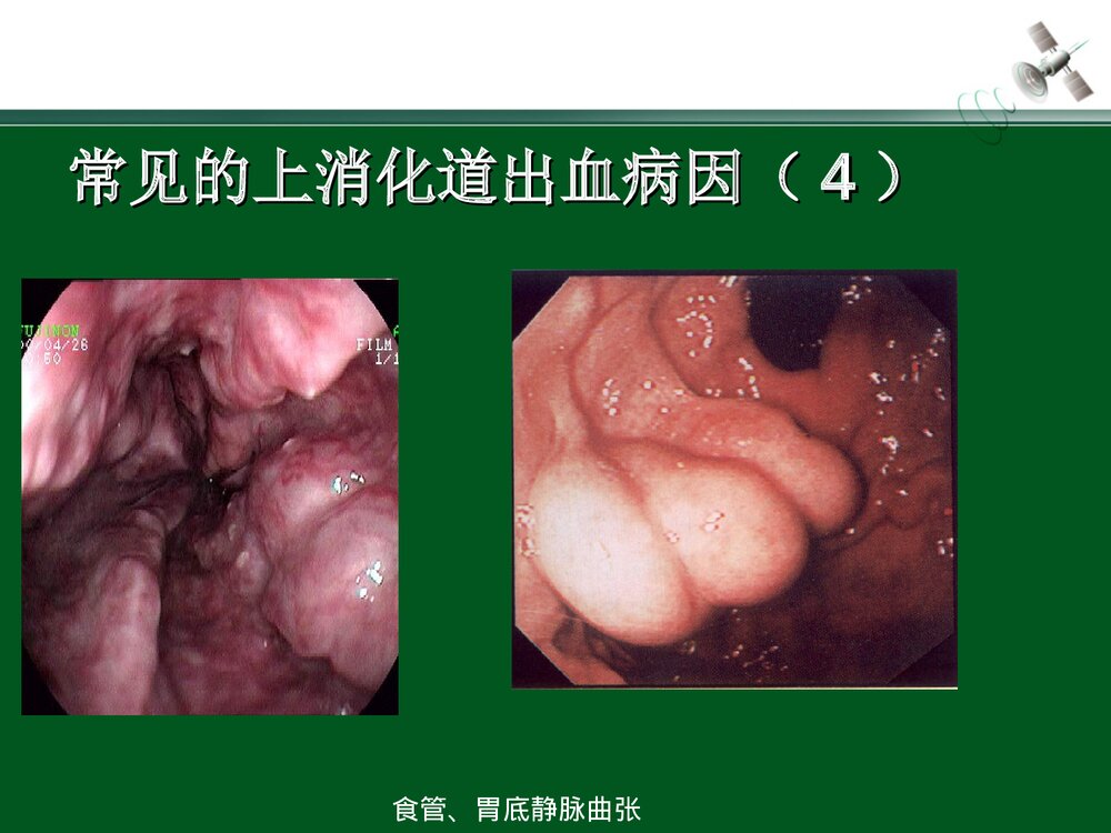 上消化道出血的急救与护理PPT课件下载(共28页)9