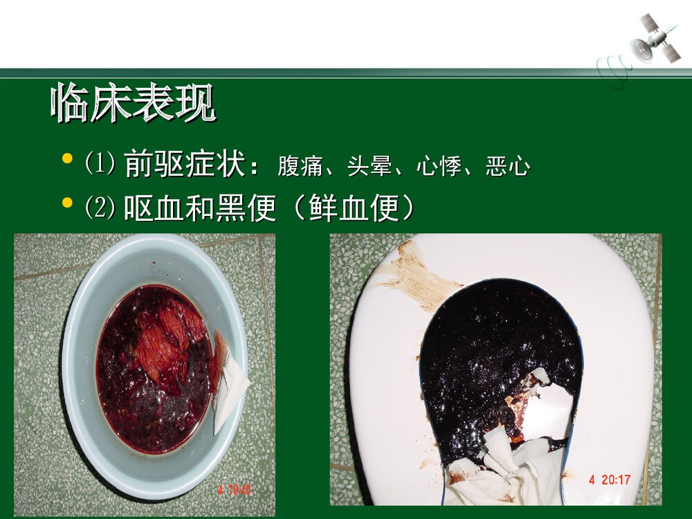 上消化道出血的急救与护理PPT课件下载(共28页)10