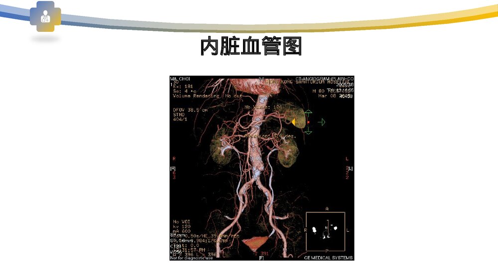 血管病变及防治PPT课件下载5