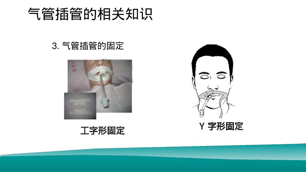 经口气管插管患者的口腔护理PPT课件下载（共16页·可编辑修改）6