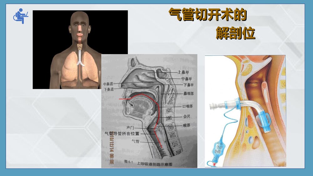 气管切开病人的伤口护理PPT课件下载(共25页·可编辑修改)4