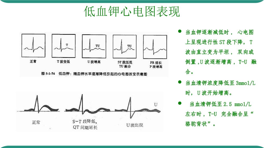 低钾血症PPT课件下载(共32页·可编辑修改)9