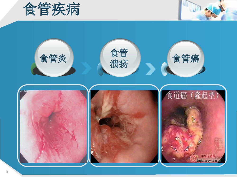 上消化道出血的护理PPT课件下载(共73页·可编辑修改)5