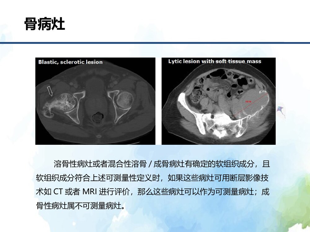 实体瘤疗效评价标准介绍(RECIST1.1)PPT课件下载8