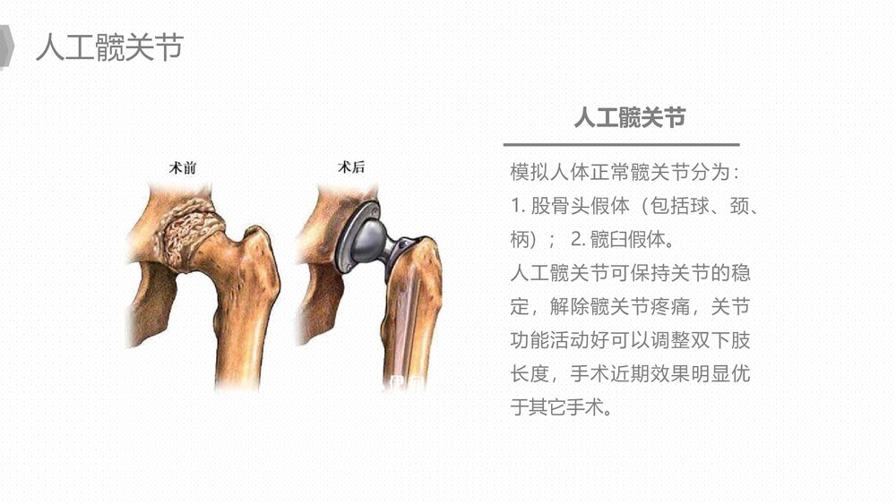 人工髋关节置换后预防下肢深静脉血栓的护理PPT课件下载7