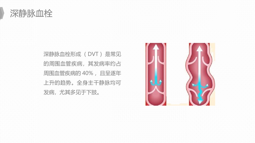 人工髋关节置换后预防下肢深静脉血栓的护理PPT课件下载8
