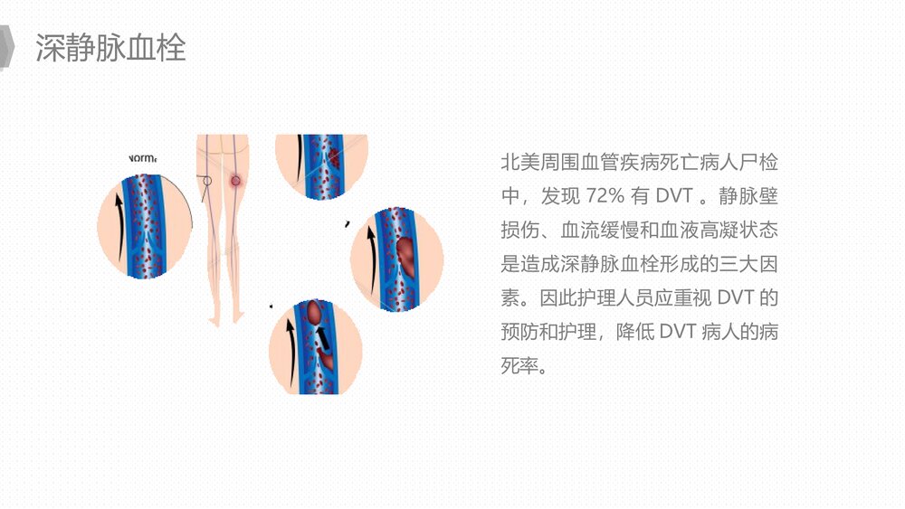 人工髋关节置换后预防下肢深静脉血栓的护理PPT课件下载9