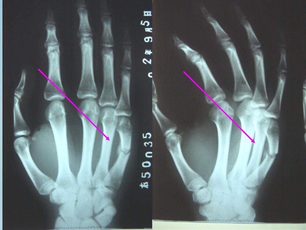 掌骨骨折PPT课件下载(共62页·可编辑修改)4