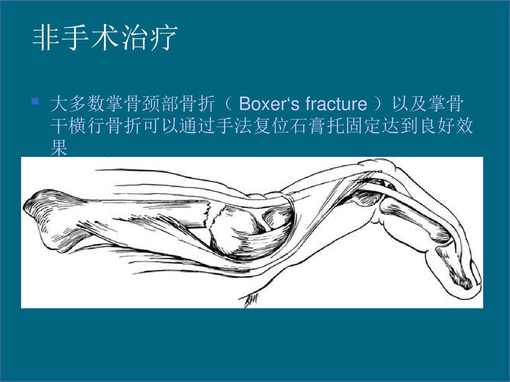掌骨骨折的治疗PPT课件下载(共48页·可编辑修改)5