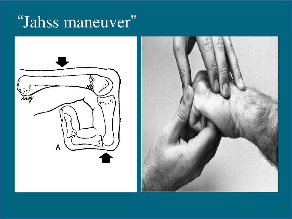 掌骨骨折的治疗PPT课件下载(共48页·可编辑修改)6