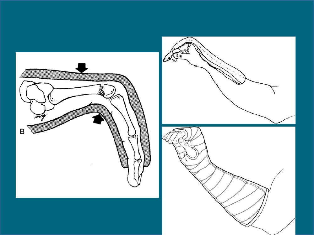 掌骨骨折的治疗PPT课件下载(共48页·可编辑修改)7