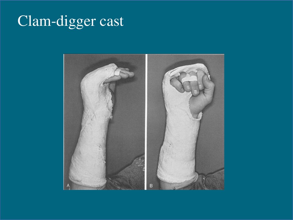 掌骨骨折的治疗PPT课件下载(共48页·可编辑修改)8