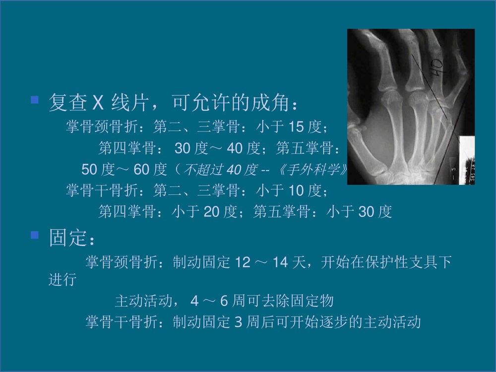 掌骨骨折的治疗PPT课件下载(共48页·可编辑修改)9