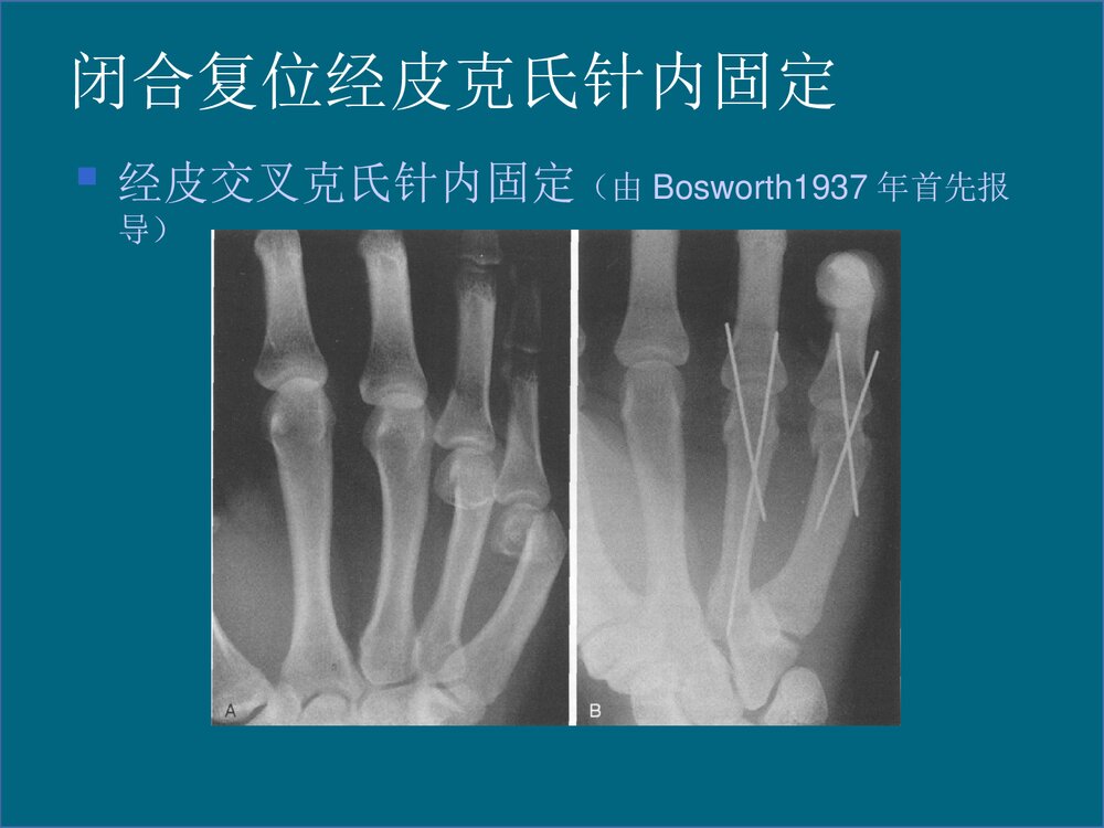 掌骨骨折的治疗PPT课件下载(共48页·可编辑修改)10