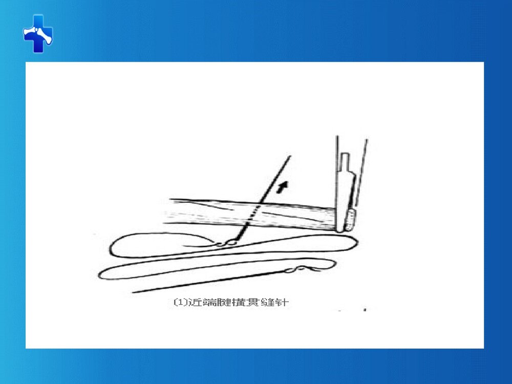 肌腱缝合术PPT课件下载(共61页·可编辑修改)7