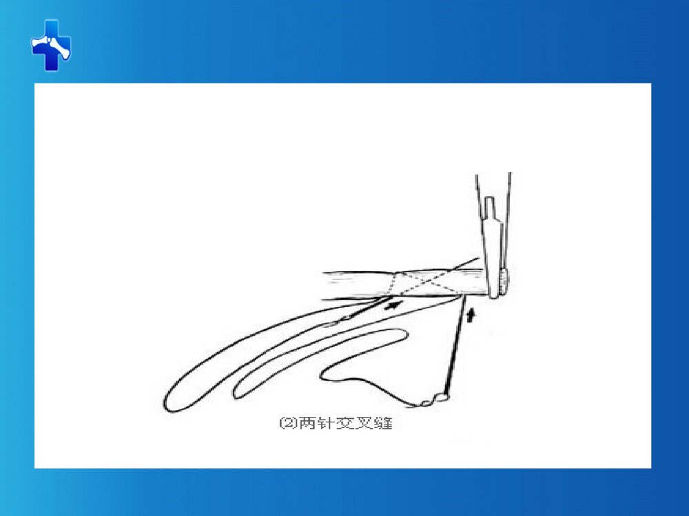 肌腱缝合术PPT课件下载(共61页·可编辑修改)8