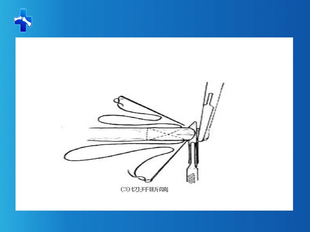 肌腱缝合术PPT课件下载(共61页·可编辑修改)9