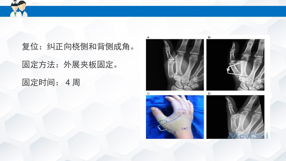 掌骨骨折患者的护理PPT课件下载(共30页·可编辑修改)8