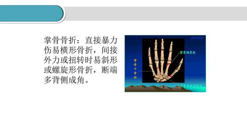 掌骨骨折的护理PPT课件(共23页·可编辑修改)3
