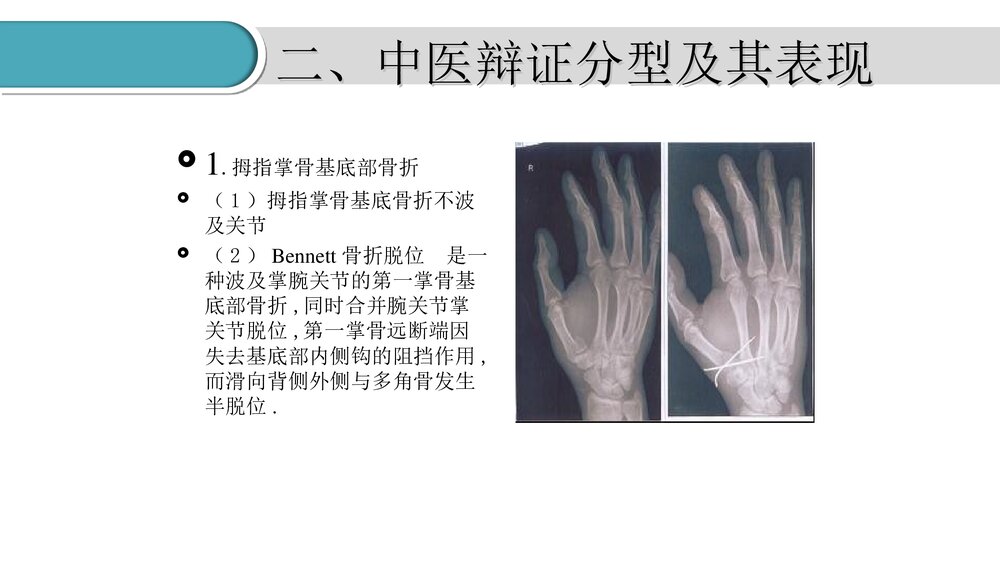 掌骨骨折的护理PPT课件(共23页·可编辑修改)6