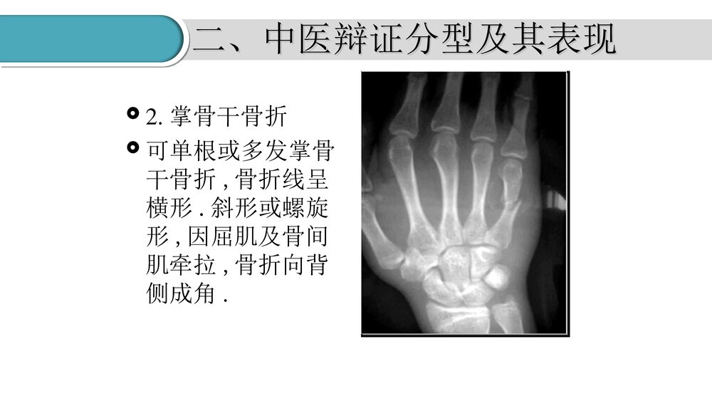 掌骨骨折的护理PPT课件(共23页·可编辑修改)7