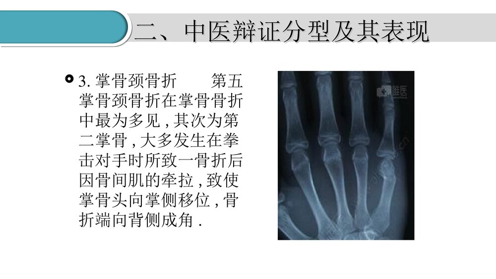 掌骨骨折的护理PPT课件(共23页·可编辑修改)8