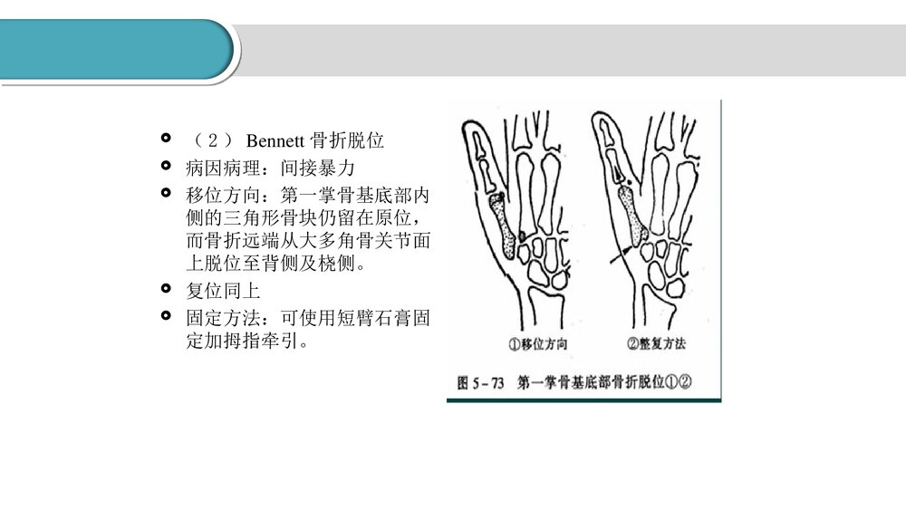 掌骨骨折的护理PPT课件(共23页·可编辑修改)10