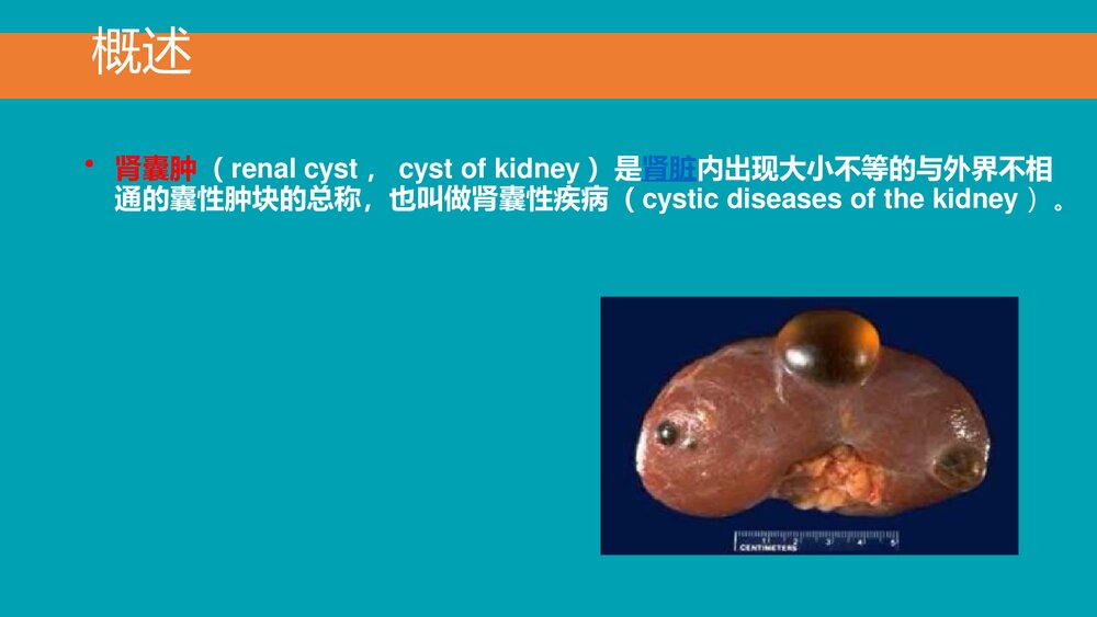 后腹腔镜下肾囊肿去顶减压术PPT课件下载(共33页·可编辑修改)5