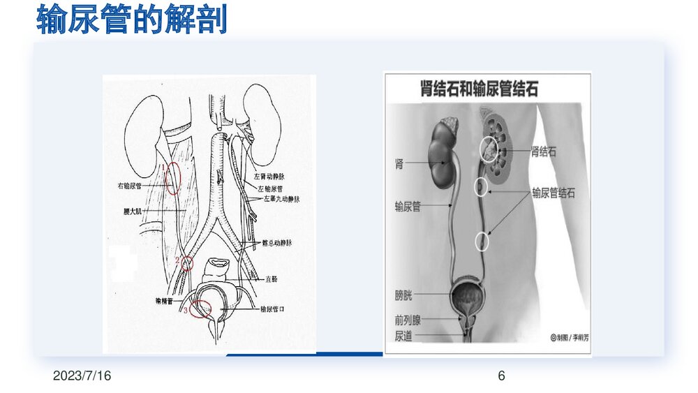 后腹腔镜下输尿管切开取石术PPT课件下载(共23页·可编辑修改)6