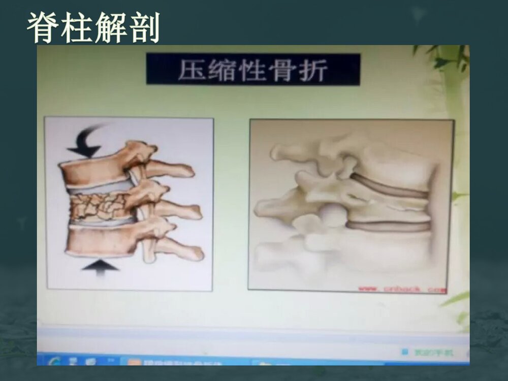 腰椎爆裂性骨折伴截瘫护理查房PPT课件下载6