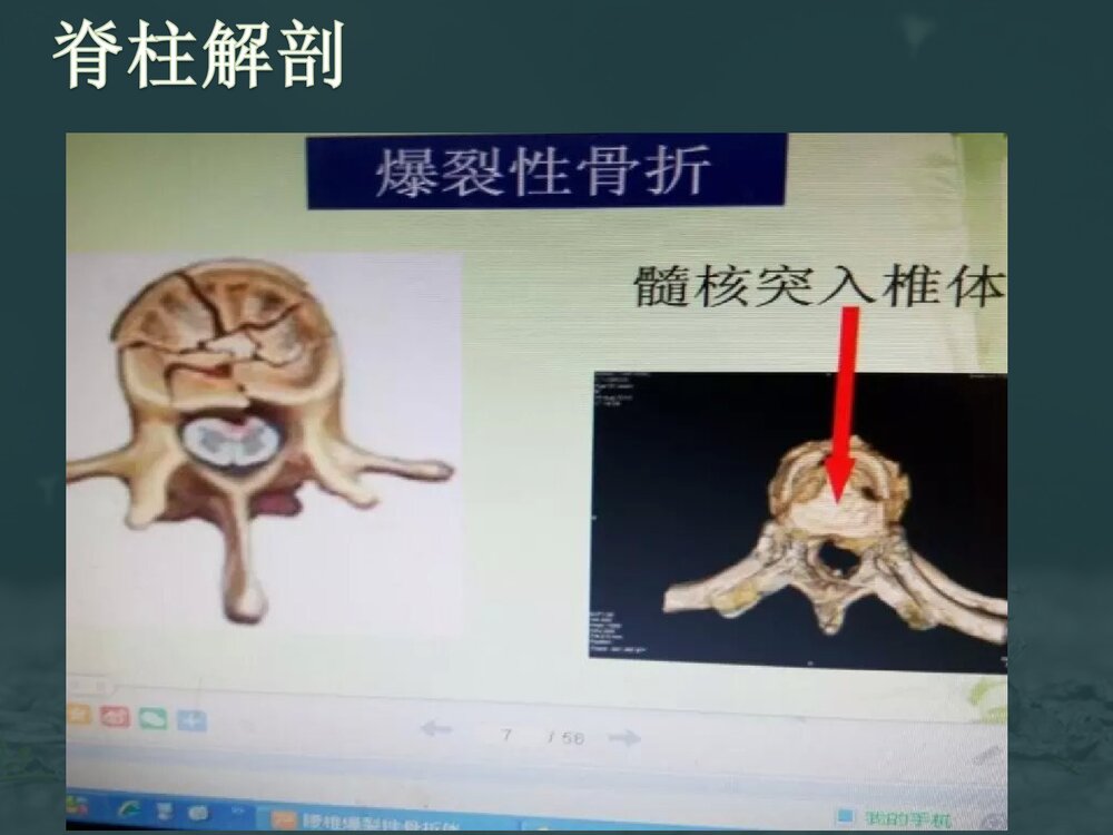 腰椎爆裂性骨折伴截瘫护理查房PPT课件下载7