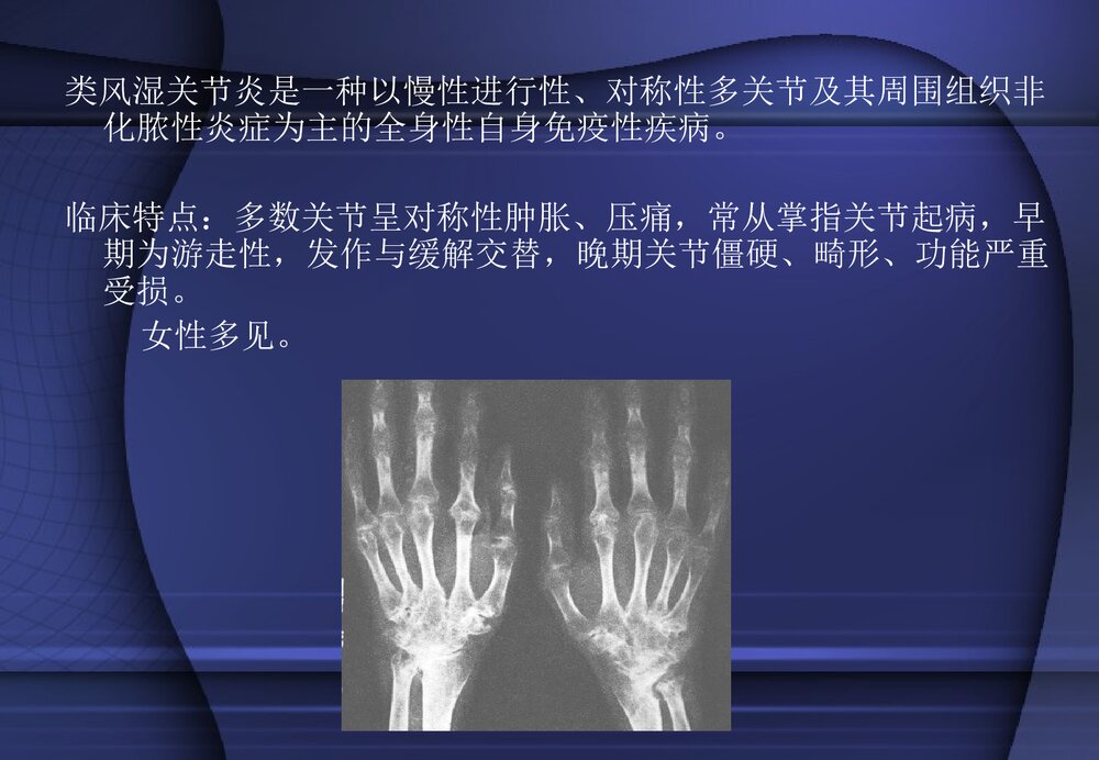 类风湿性关节炎PPT课件2