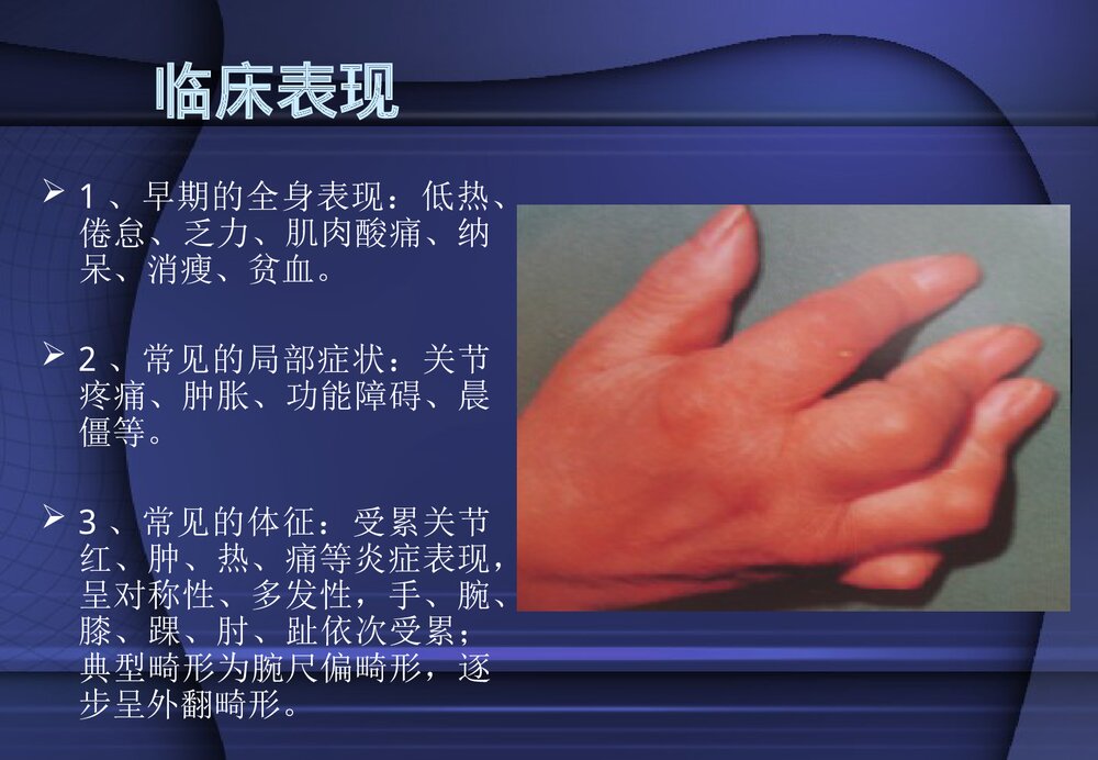 类风湿性关节炎PPT课件7