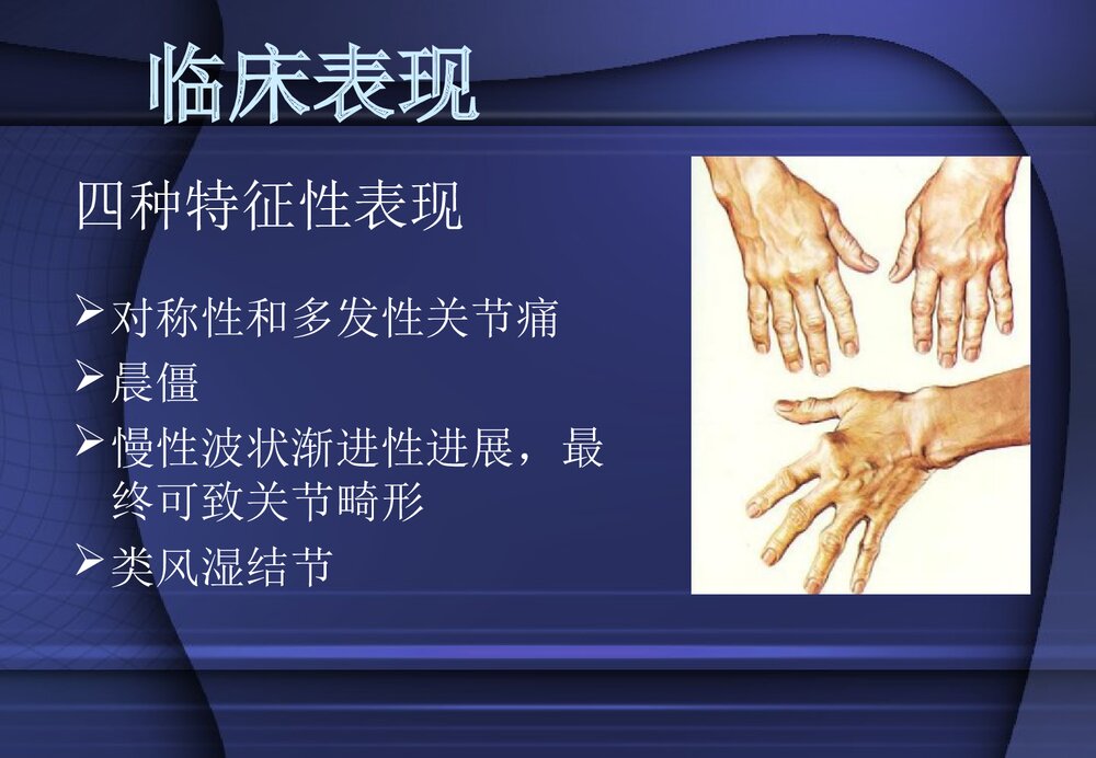 类风湿性关节炎PPT课件8